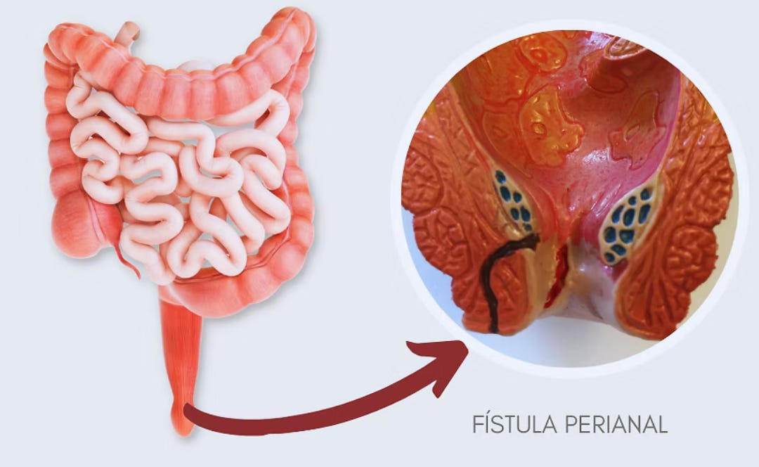 Fístula perianal: o que é, sintomas, tratamento e cirurgia