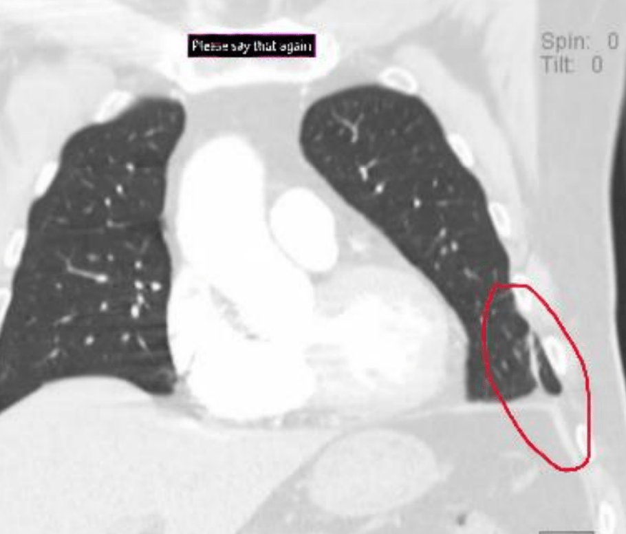 CT scan of the chest showing an abnormality in the right lung. CT scan of the chest showing an abnormality in the right lung.
