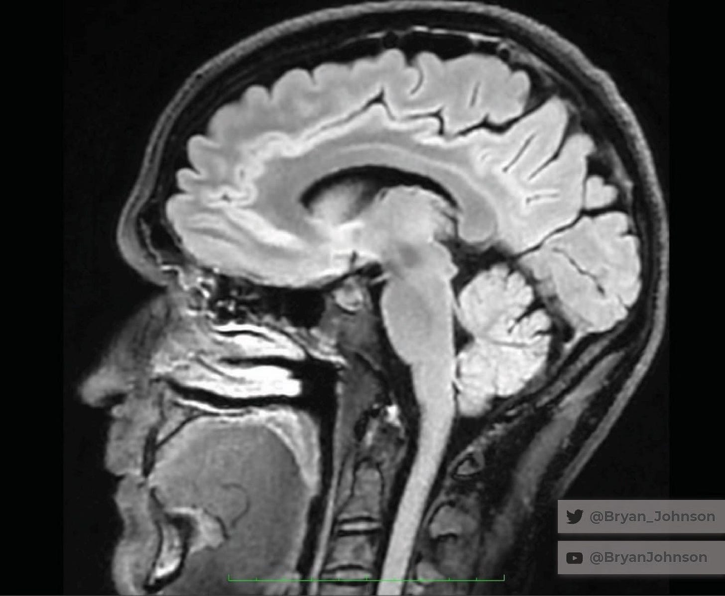 MRI image used in Bryan Johnson’s Blueprint measurements