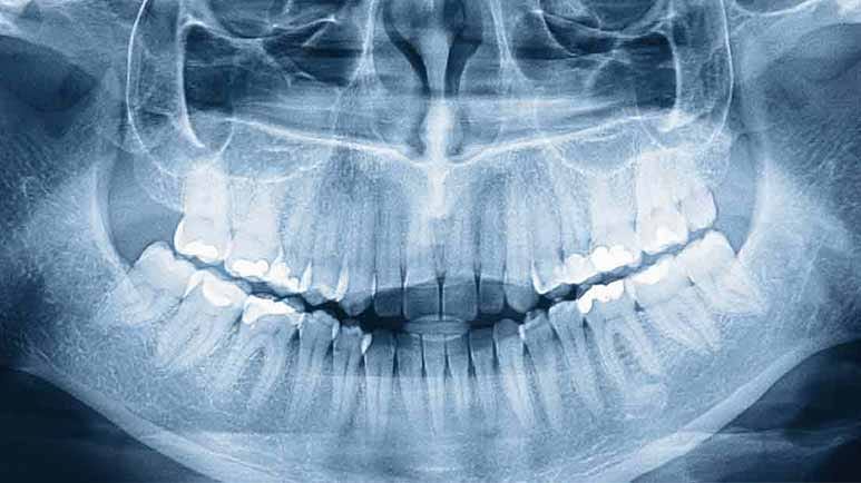 third set of teeth