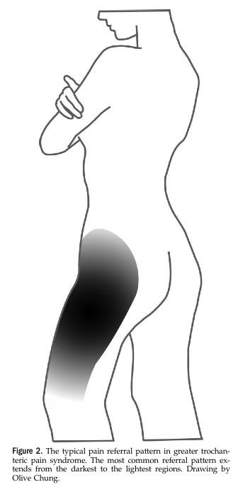 Gluteal Tendinopathy - RunningPhysio