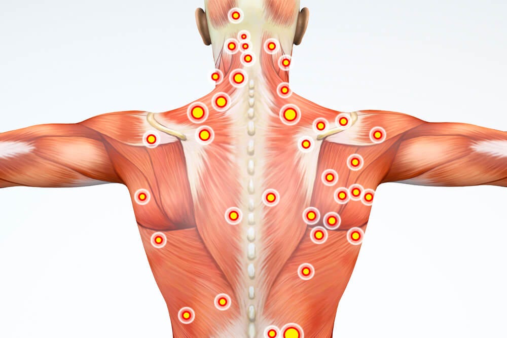 Muscle Trigger Point Pain & Myofascial Release Therapy - Integrated  Chiropractic