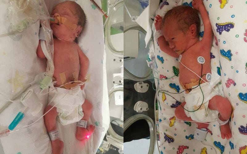 Surviving fraternal twins from triplets