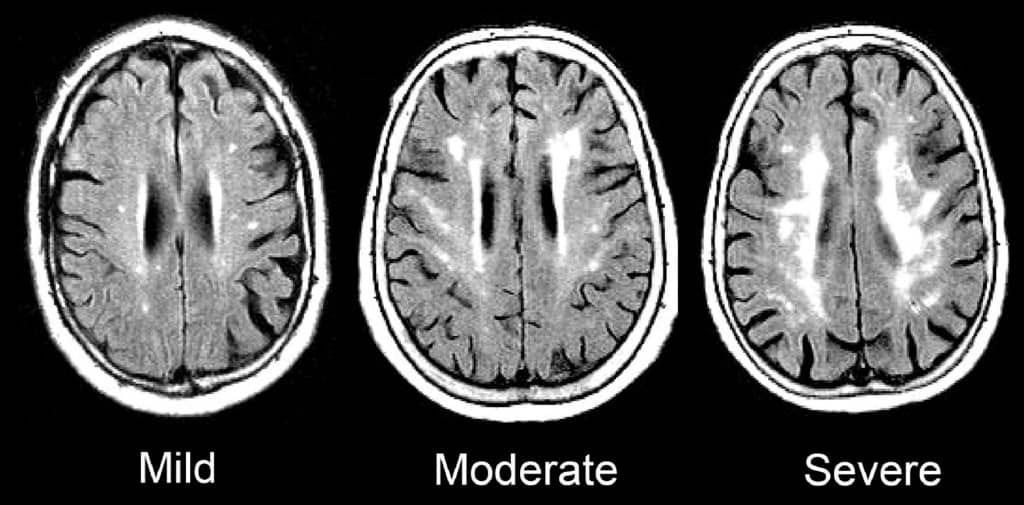 Brain scans showing signs of cerebral small vessel disease.