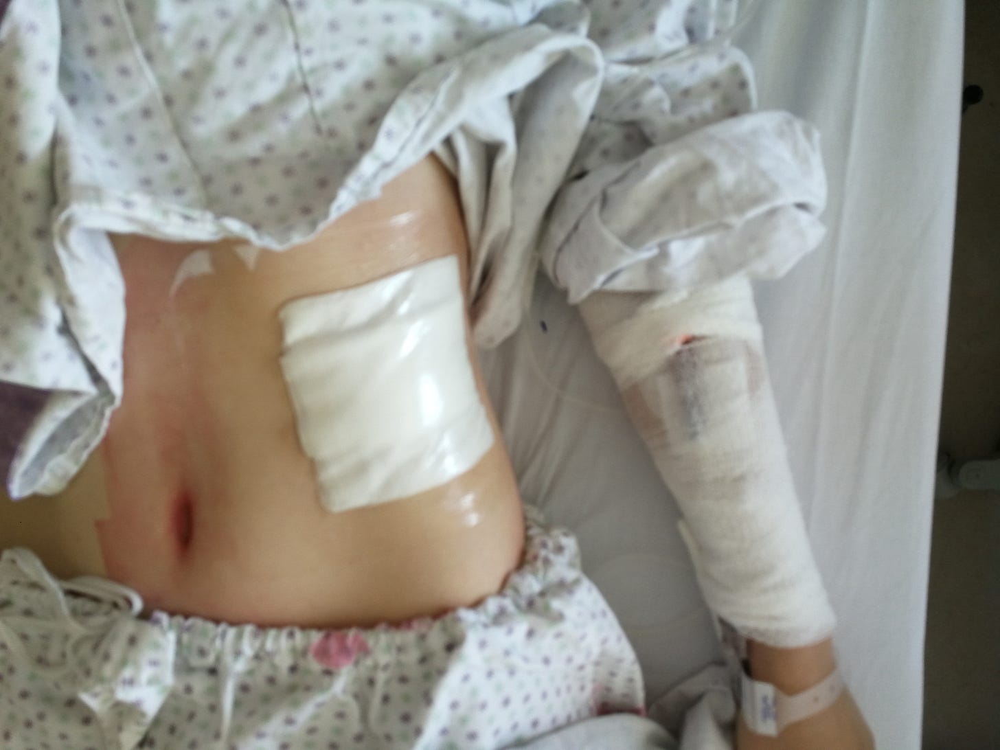 spleen cyst puncture