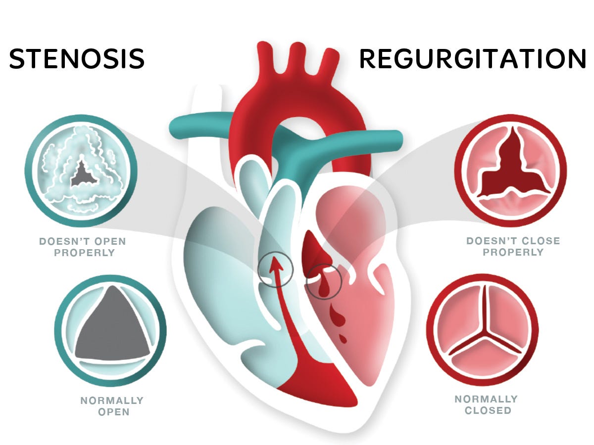 What Is Heart Valve Disease? - Heart Foundation NZ