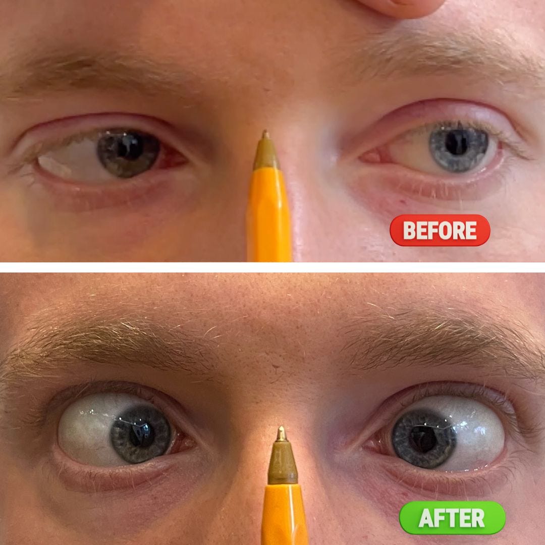 Lazy Eye Correction With NeuroVision