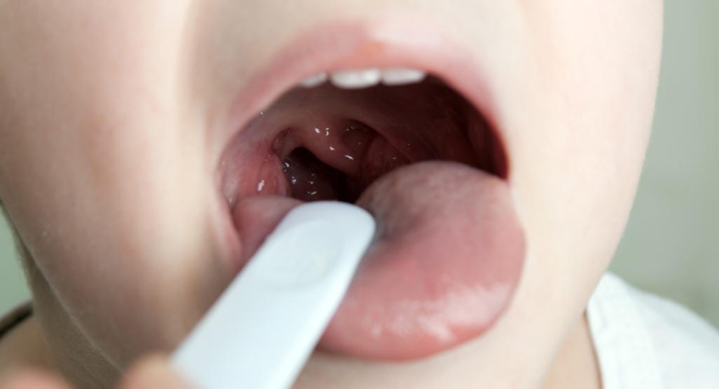 Amigdalite em crianças: sintomas, cuidados, tratamento - BabyCenter