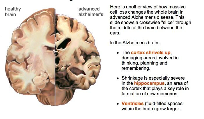 Normal vs. Alzheimers brain hemispheres | Alzheimer's brain, Healthy brain, Alzheimers