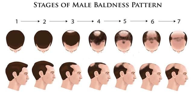 Causes of Male Pattern Baldness and Prevention | Hair sure
