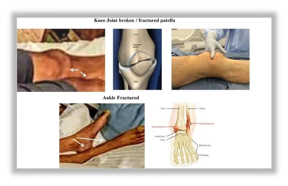 Broken legs of Sushant Singh Rajput