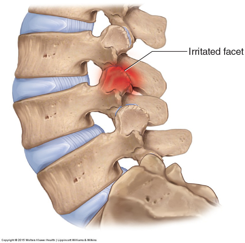 Stiff lower back or Facet Joint Sprain - Back in Action