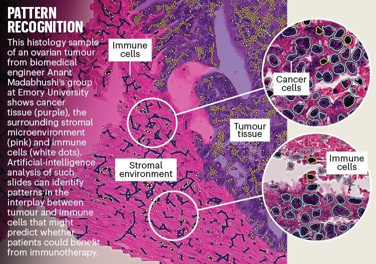Pattern recognition: histology sample of an ovarian tumour showing cancer tissue, the stromal microenvironemnt and immune cells