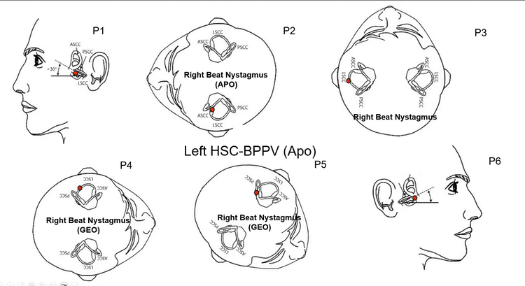The Unique Nystagmus of the Zuma Maneuver for Apogeotropic