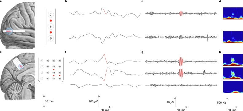 High-density ECoG improves the detection of high frequency oscillations  that predict seizure outcome - ScienceDirect