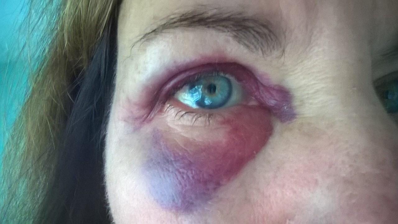 Os riscos da Harmonização facial