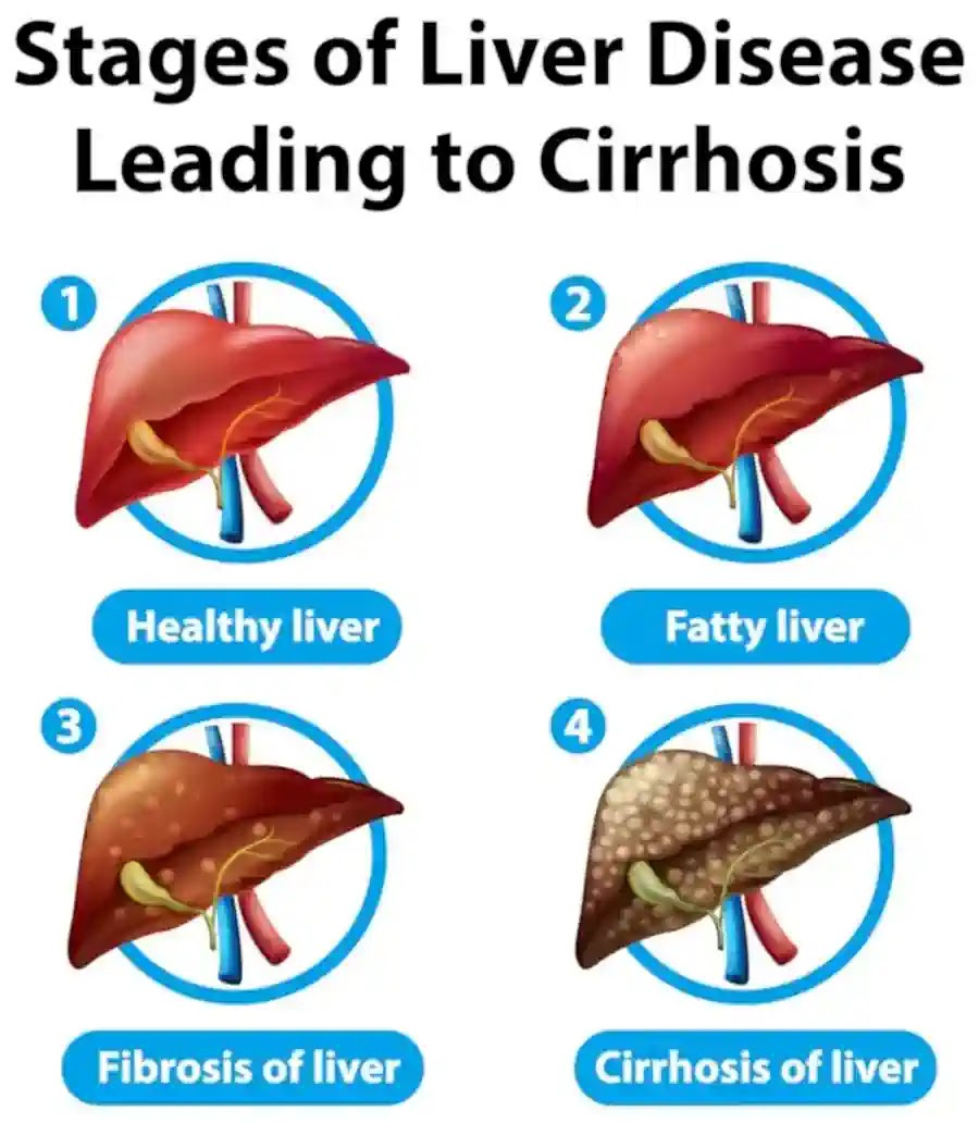 Liver disease's four stages from mild inflammation to cirrhosis causing serious complications.