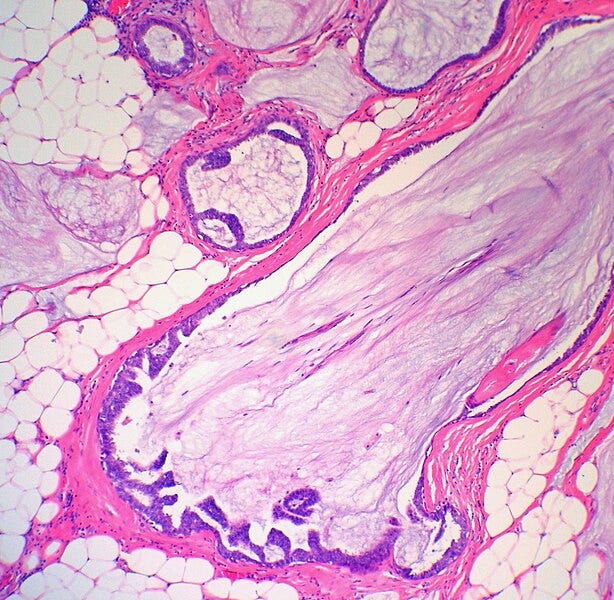 File:Breast DCIS Mucinous Extravasation MP3 PA.JPG File:Breast DCIS Mucinous Extravasation MP3 PA.JPG
