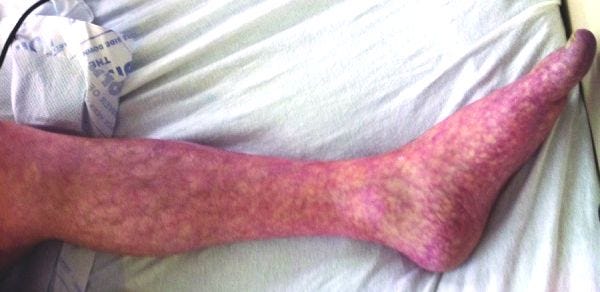 Livedo reticularis of left leg.jpg Livedo reticularis of left leg.jpg