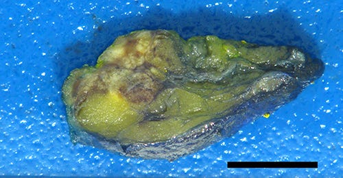 Excisional biopsy of mass Excisional biopsy of mass
