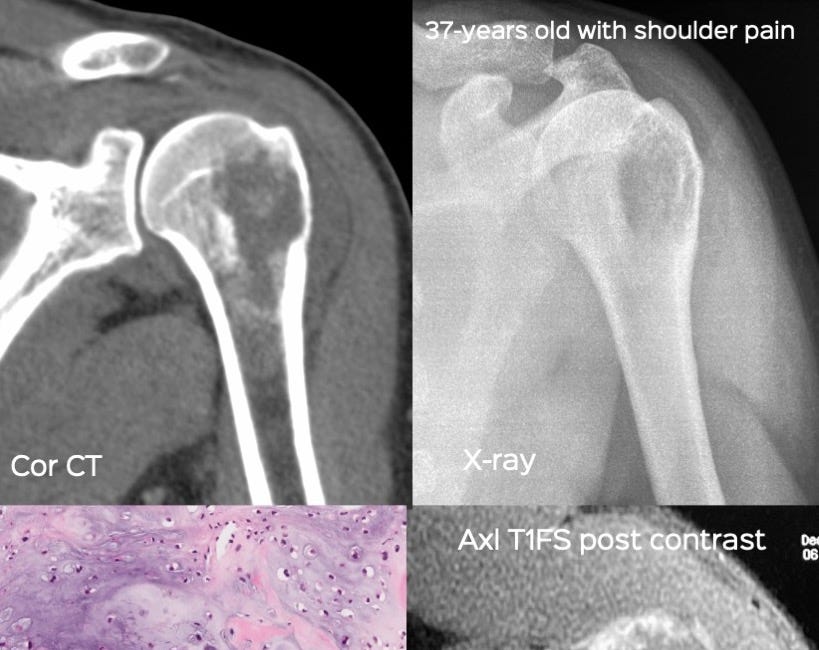 Case 15: A Proximal Humerus Lesion