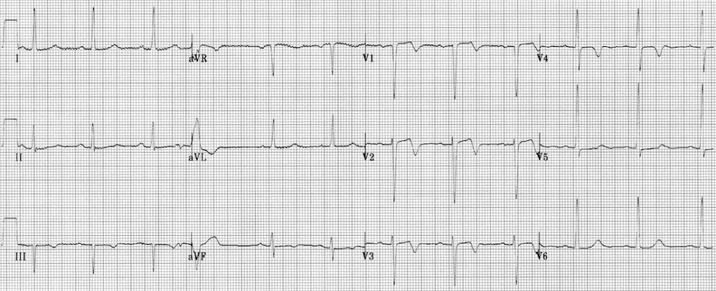 Wellens Syndrome (Type A Pattern)﻿ 2
