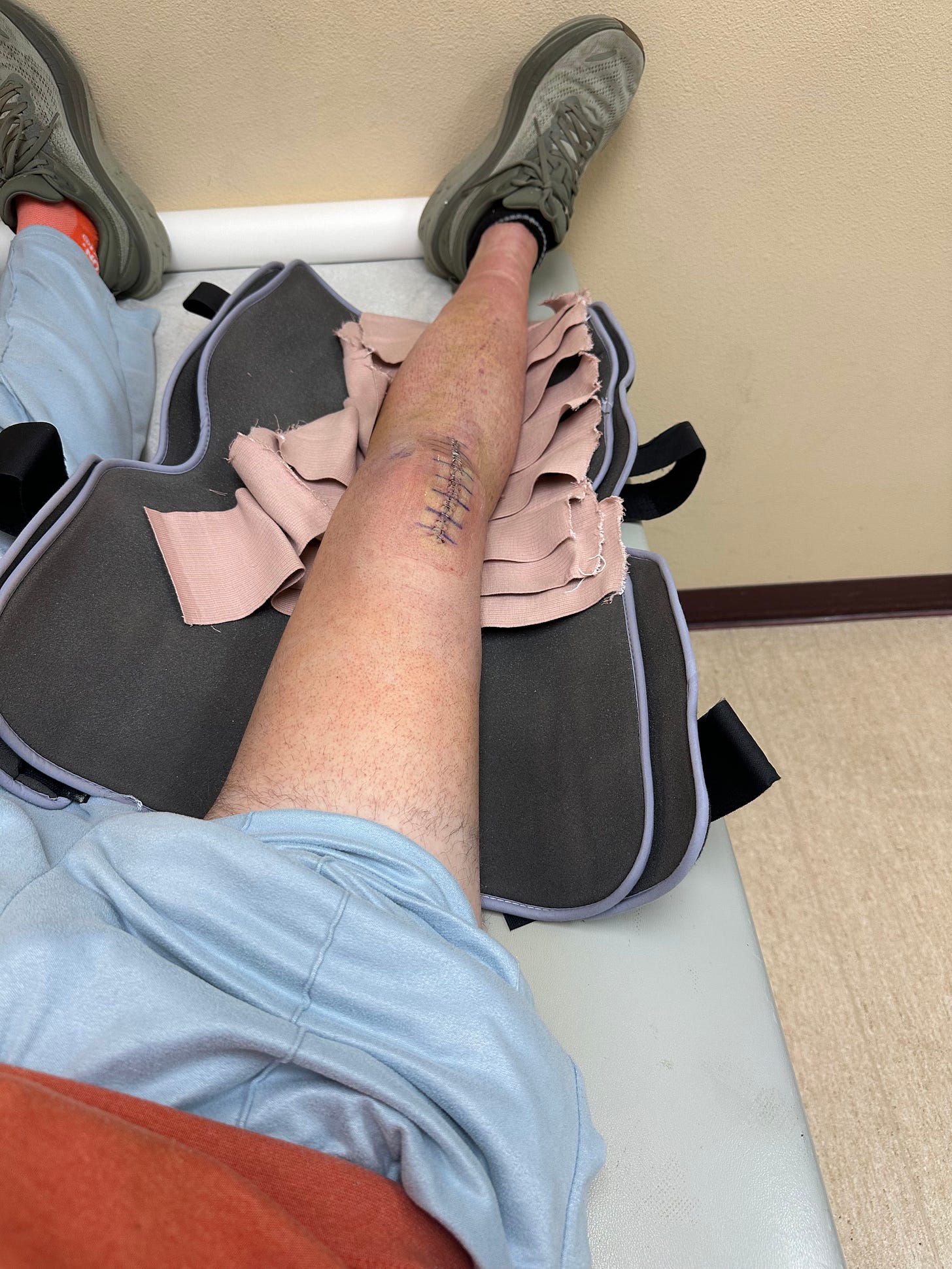 Leg in a brace showing surgical staples and bruising.