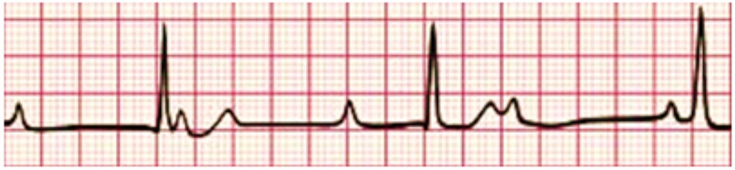 Single-lead ECG rhythm strip showing complete heart block: AV dissociation with independent P waves and narrow QRS escape rhythm