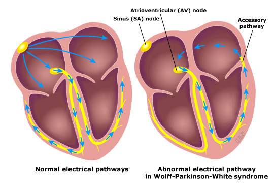 This is a figure titled Wolff-Parkinson-White syndrome. Legend: Patients with WPW syndrome have an extra electrical pathway between the atria and the ventricles, known as an accessory pathway. The abnormal pathway directly connects the atria and ventricles and bypasses the AV node, which is the slowest conducting part of the heart's electrical system. As a result, the normal sinus impulse can travel down the normal pathway through the AV node, as well as the more rapidly conducting accessory pathway. This allows the impulse traveling through the accessory pathway to reach the ventricle earlier, causing what is termed "preexcitation."
