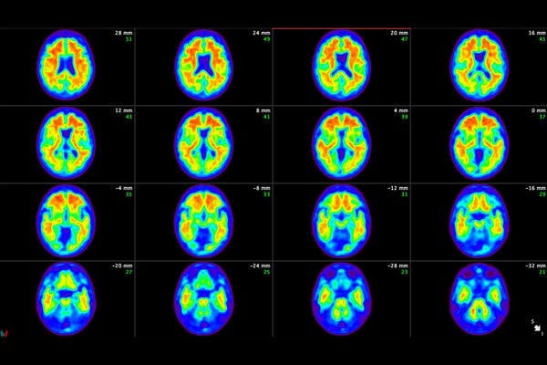 Rows of PET scans of a human brain against a black background.