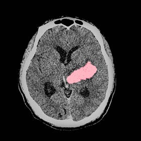 Minimally-invasive surgery to evacuate intracerebral hemorrhages improved outcomes (ENRICH trial)