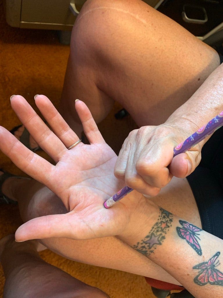 Simple Fix For Carpel Tunnel Syndrome
