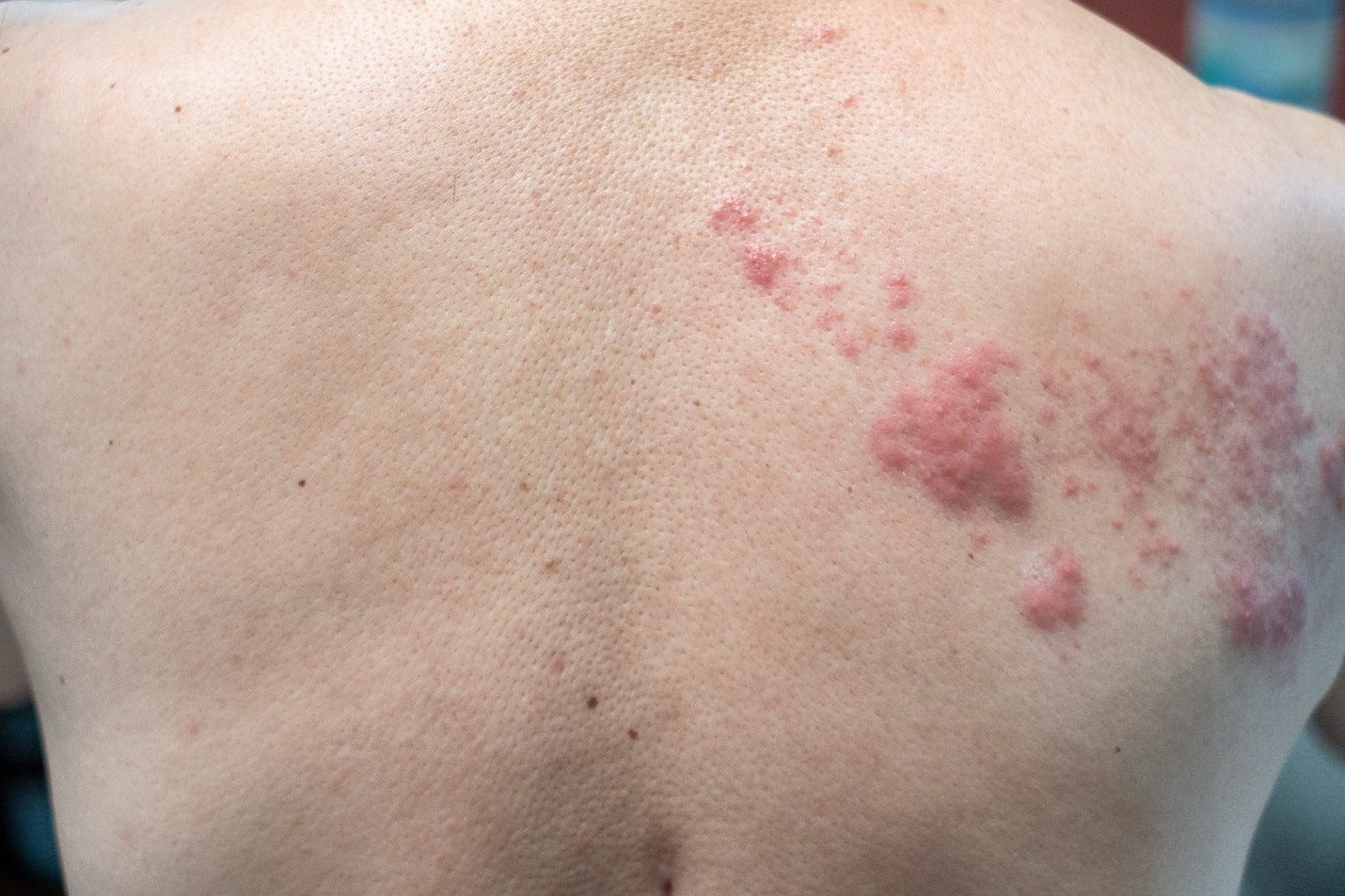 Shingles | Family Doctor Shingles | Family Doctor