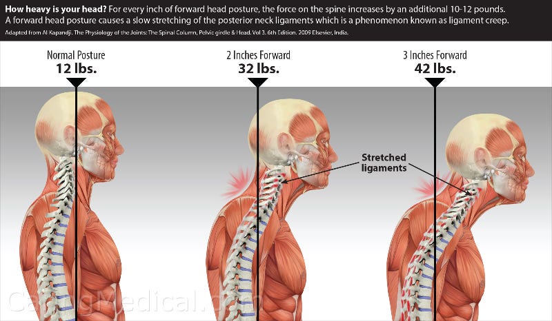 Forward head posture symptoms and complications - Hauser Neck Center Fort  Myers -