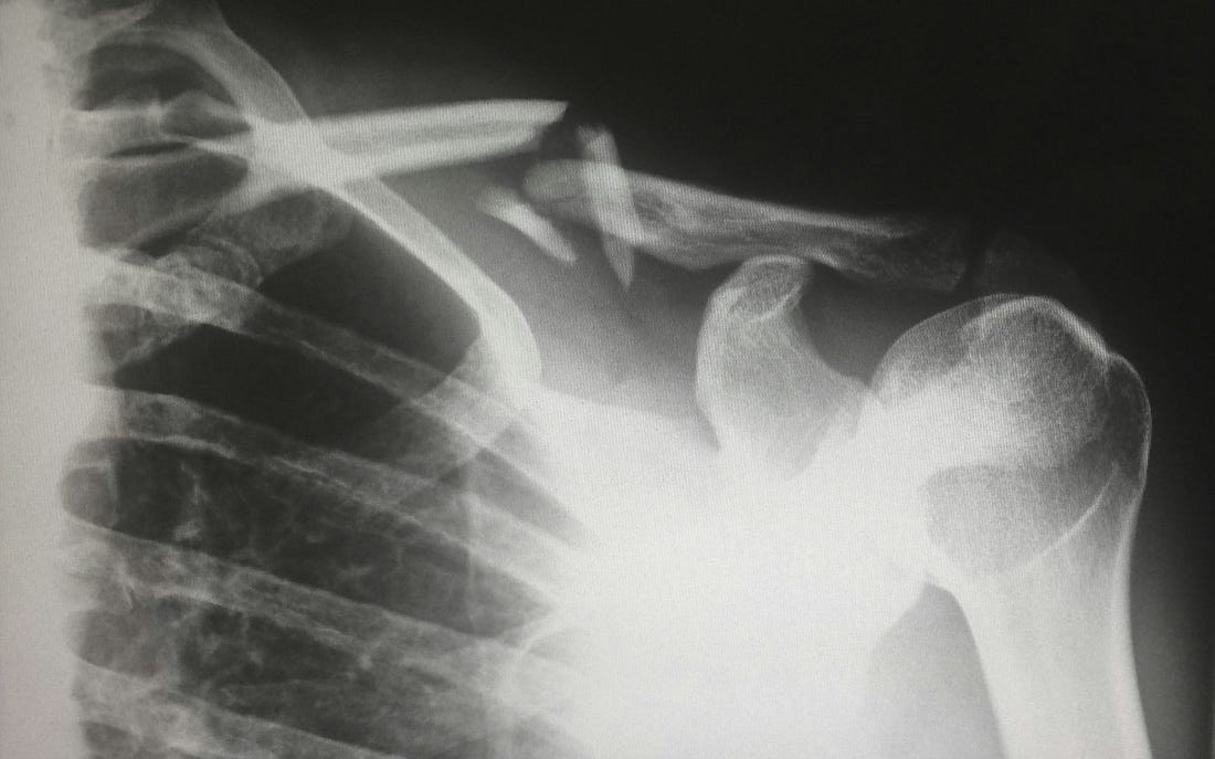 bone fracture due to osteoporosis in menopause