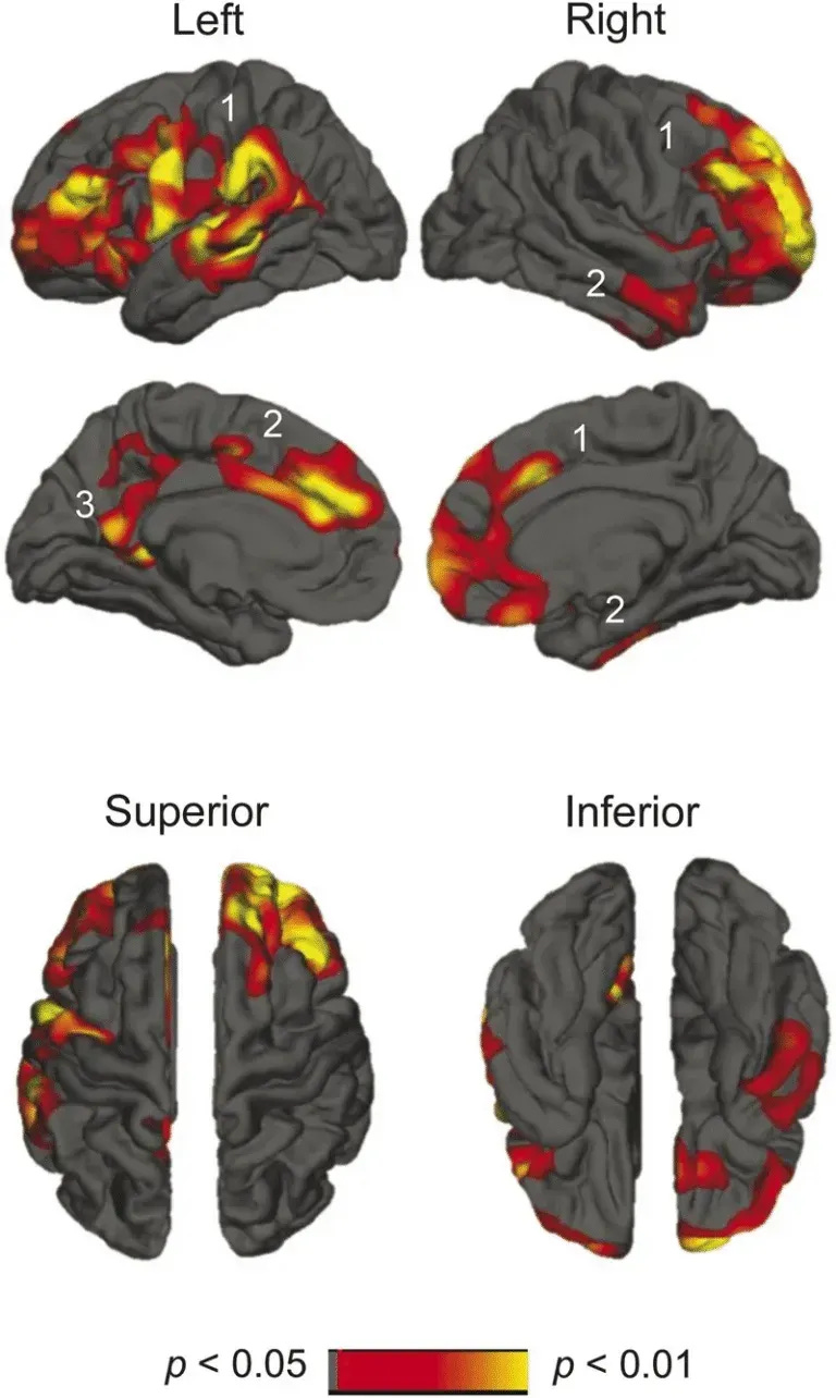 Spatial maps showing increased rate of cortical atrophy in multiple cortical regions with poor sleep quality. stay asleep longer than 5–6 hours