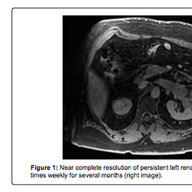 Case Report: Renal Cell Carcinoma, age 63, Male