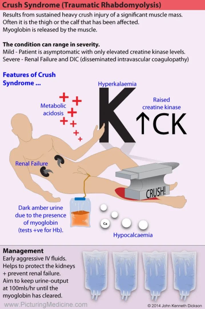 Crush Syndrome (Traumatic Rhabdomyolysis)