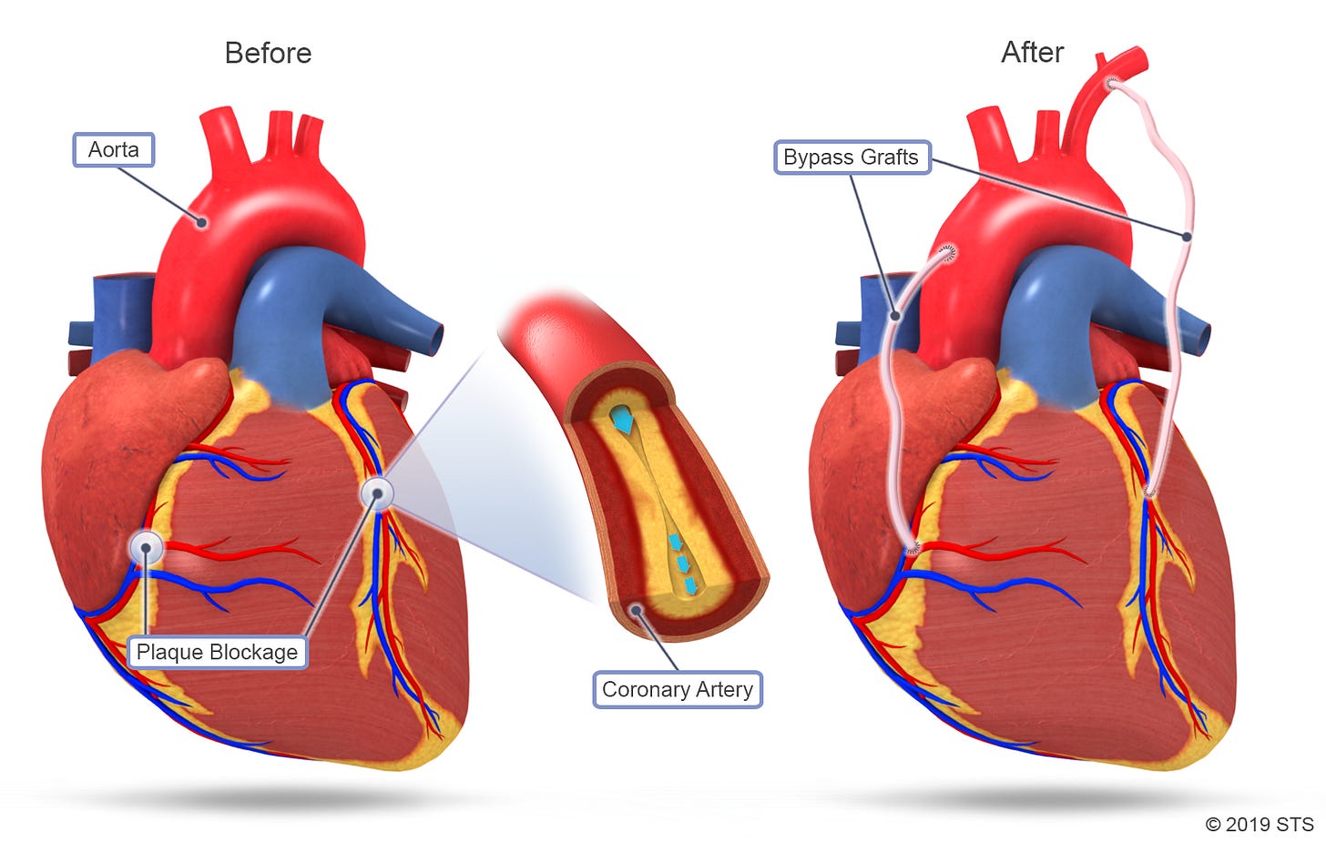 Coronary Artery Bypass Grafting (CABG) | The Patient Guide to Heart, Lung,  and Esophageal Surgery