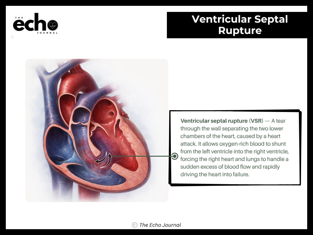 Intraventricular Rupture Ventricular Septal Rupture: The Echo That Changes Everything
