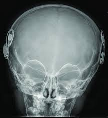 AP skull radiograph of correctly placed bilateral cochlear implants. |  Download Scientific Diagram