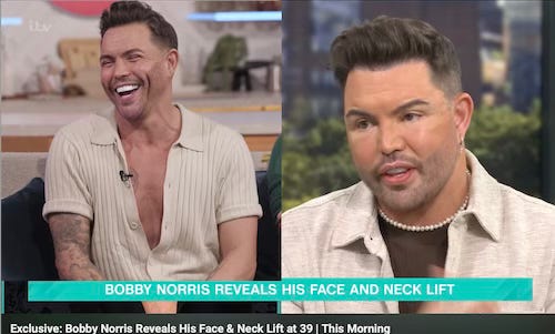 A screenshot from This Morning showing a side by side comparison of Bobby Norris before and after surgery – his post-surgery face is much puffier