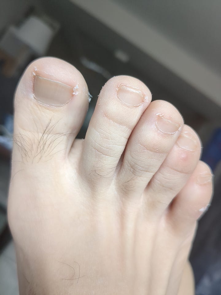 CAPTION: Late stage skin loss on hands and feet of the author days and weeks following a ketoacidosis induced metabolic coma