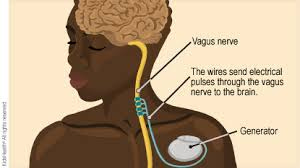Vagus Nerve Stimulator Therapy for ... Vagus Nerve Stimulator Therapy for ...