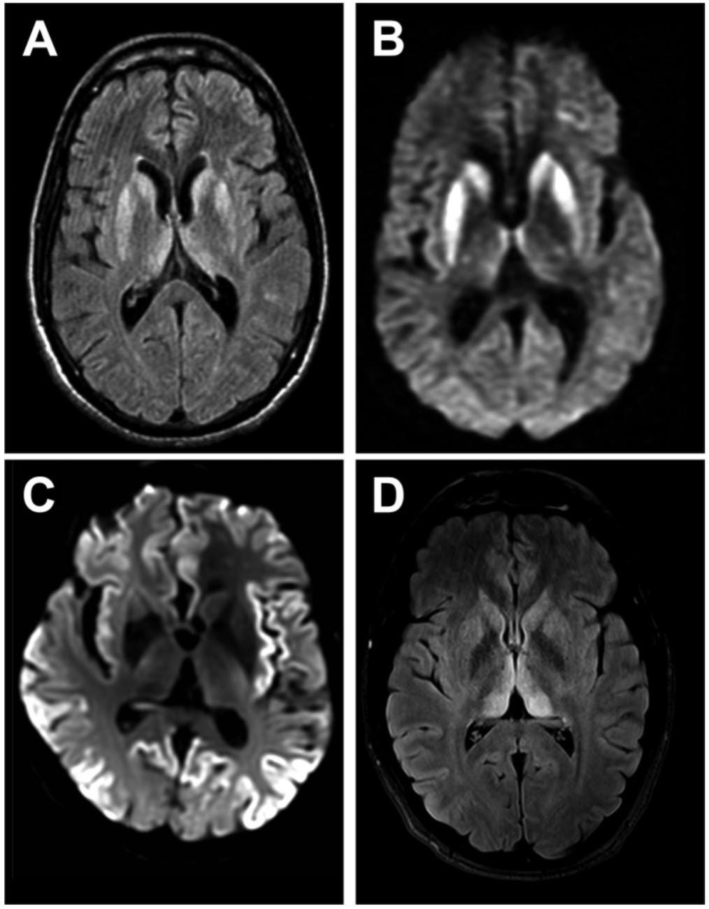 Creutzfeldt–Jakob disease