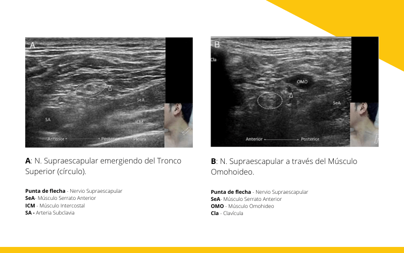 1. Nervio supraescapular ecografia tempo formacion.png