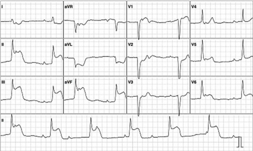 Image of 12-lead ECG Image of 12-lead ECG