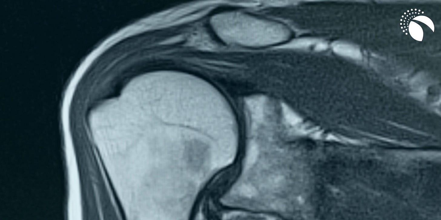 MRI Shoulder
