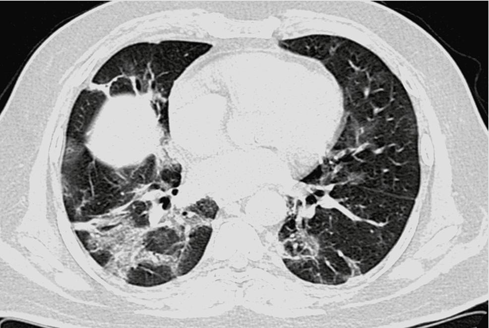 Axial-CT-section-of-the-chest-showing-consolidation-in-a-patient-with-COVID-19-pneumonia Axial-CT-section-of-the-chest-showing-consolidation-in-a-patient-with-COVID-19-pneumonia