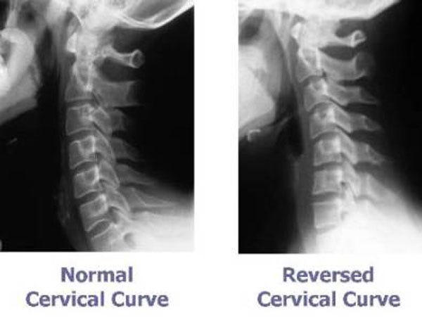 Neck Out Forward Forward Head Posture: Why Your Neck Pain Isn’t Just About the Neck